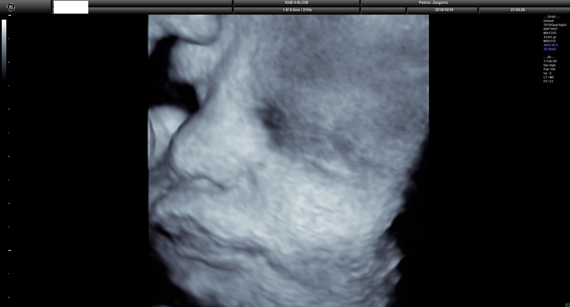 Εμβρυο 36 Εβδομάδων Προγεννητική Υπερηχογραφία 3D 12